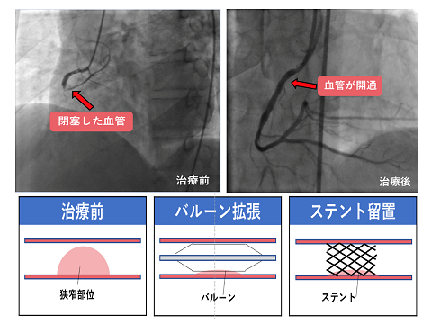 心臓 カテーテル と は