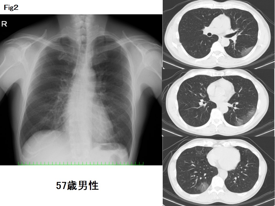 レントゲン 肺炎 - ✓［医師監修・作成］肺炎の原因は？診断は 