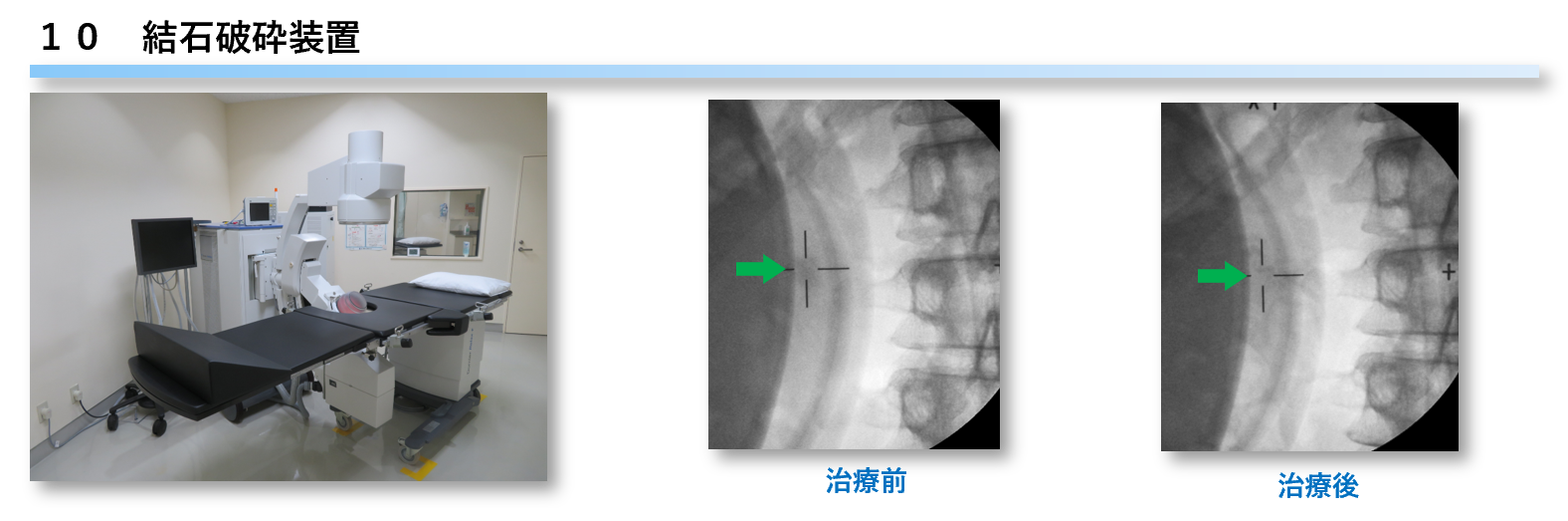 結石破砕装置